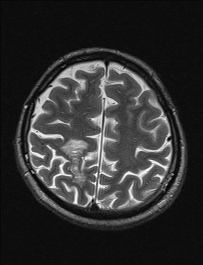 File:Balo concentric sclerosis (Radiopaedia 50458-55940 Axial T2 10).jpg