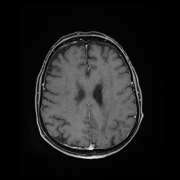 Balo concentric sclerosis (Radiopaedia 53875-59982 Axial LAVA C+ 175).jpg