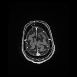Balo concentric sclerosis (Radiopaedia 53875-59982 Axial LAVA C+ 234).jpg