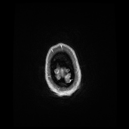 Balo concentric sclerosis (Radiopaedia 53875-59982 Axial LAVA C+ 254).jpg