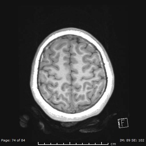 Balo concentric sclerosis (Radiopaedia 61637-69636 Axial T1 74).jpg