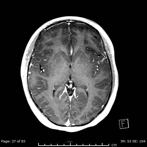 File:Balo concentric sclerosis (Radiopaedia 61637-69636 Axial T1 C+ 37).jpg