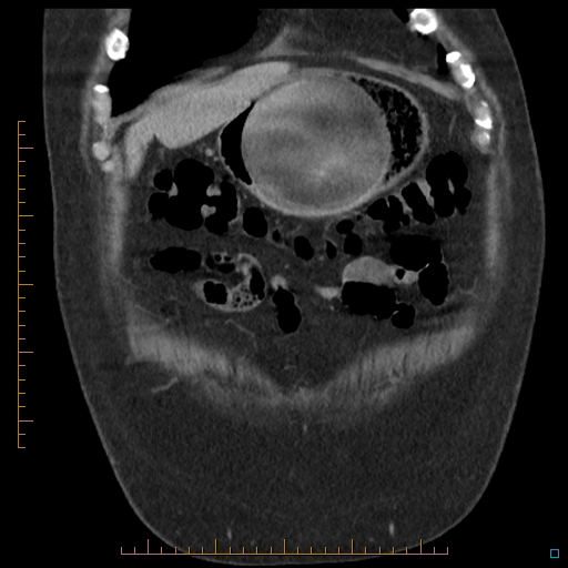 File:Bariatric balloon causing gastric outlet obstruction (Radiopaedia 54449-60672 B 8).jpg