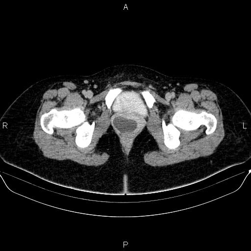 Bartholin gland cyst (Radiopaedia 62635-70930 C 77).jpg