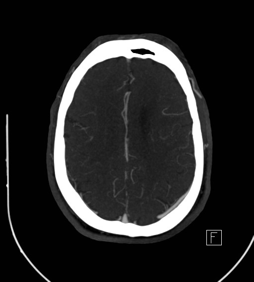 Basilar artery thrombosis (Radiopaedia 26986-27163 A 62).jpg
