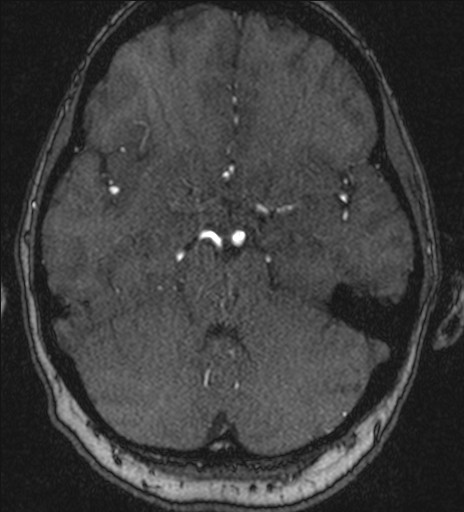 Basilar tip aneurysm (Radiopaedia 26504-26632 MRA 80).jpg