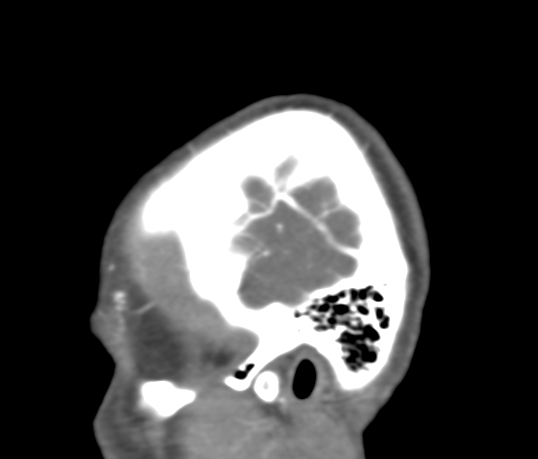 File:Basilar tip aneurysm with coiling (Radiopaedia 53912-60086 C 5).jpg