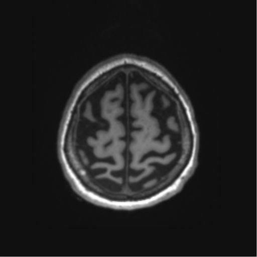 Behavioral variant frontotemporal dementia and late onset schizophrenia (Radiopaedia 52197-58083 Axial T1 4).png