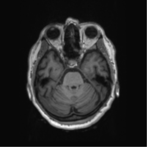 Behavioral variant frontotemporal dementia and late onset schizophrenia (Radiopaedia 52197-58083 Axial T1 76).png