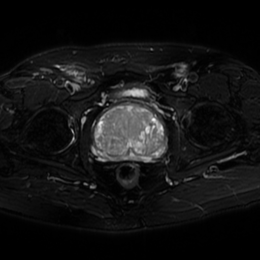 File:Benign prostatic nodular hyperplasia (Radiopaedia 16917-16634 Axial T2 fat sat 9).jpg