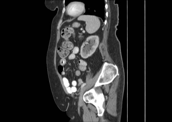 Bicameral celiacomesenteric aneurysm (Radiopaedia 55766-62327 B 41).jpg