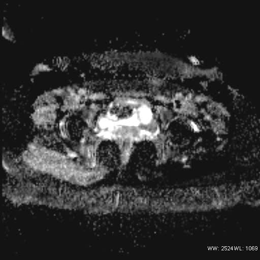 File:Bicornuate uterus- on MRI (Radiopaedia 49206-54297 Axial ADC 18).jpg