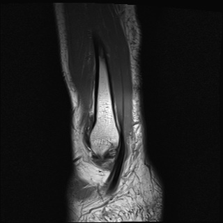 File:Bilateral Achilles tendon complete tear (Radiopaedia 81344-95051 Sagittal T1 30).jpg