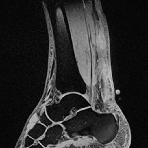 Bilateral Achilles tendon complete tear (Radiopaedia 81344-95051 Sagittal WE - Right 58).jpg