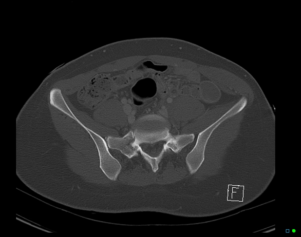 Bilateral acetabular fractures (Radiopaedia 79272-92308 Axial bone window 15).jpg