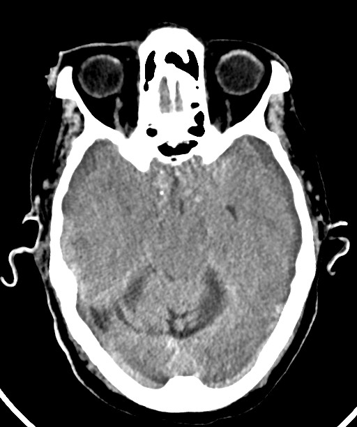 Bilateral acute on chronic subdural hematomas (Radiopaedia 78466-91146 Axial non-contrast 23).jpg