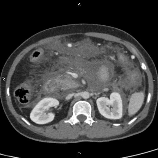 Bilateral adrenal gland hyperenhancement in pancreatitis (Radiopaedia 86642-102753 E 43).jpg