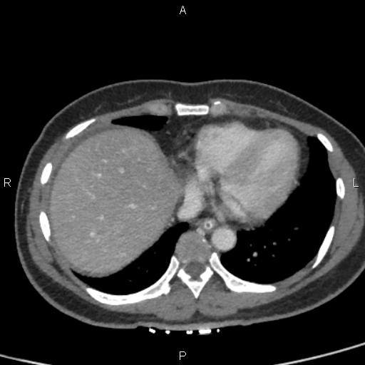 Bilateral adrenal gland hyperenhancement in pancreatitis (Radiopaedia 86642-102753 E 6).jpg