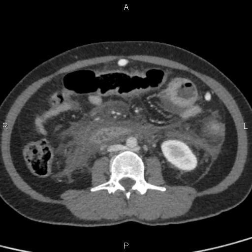 File:Bilateral adrenal gland hyperenhancement in pancreatitis (Radiopaedia 86642-102753 E 62).jpg