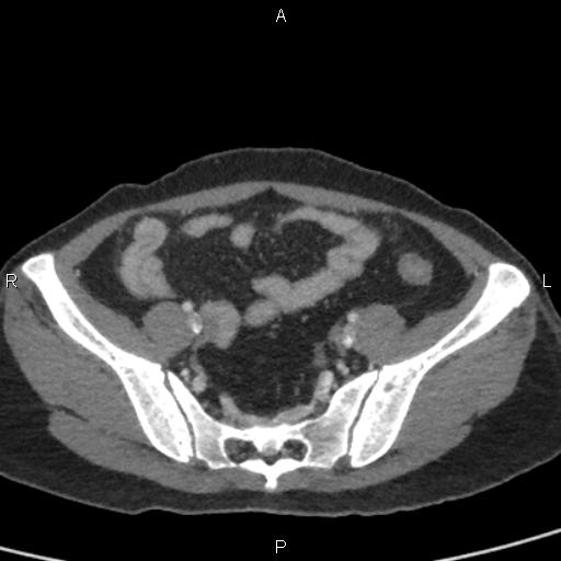 Bilateral adrenal gland hyperenhancement in pancreatitis (Radiopaedia 86642-102753 E 89).jpg