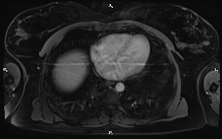 Bilateral adrenal myelolipoma (Radiopaedia 63058-71537 G 7).jpg