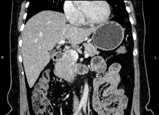 Bilateral benign adrenal adenomas (Radiopaedia 86912-103124 D 24).jpg