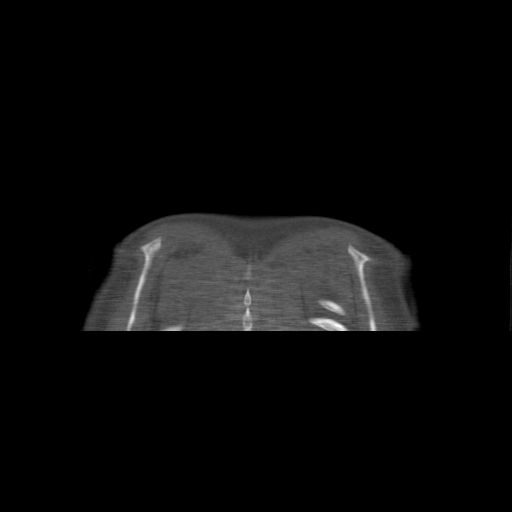 Bilateral chronic posterior shoulder dislocation (Radiopaedia 39213-41452 Coronal bone window 62).jpg