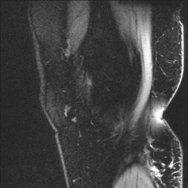 Bilateral focal pigmented villonodular synovitis (Radiopaedia 67643-77046 G 5).jpg