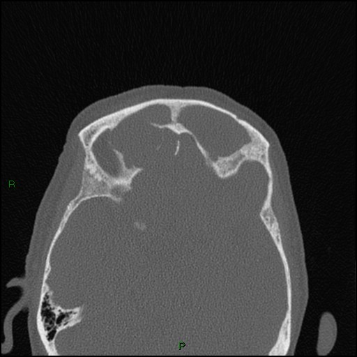 Bilateral frontal mucoceles (Radiopaedia 82352-96454 Axial bone window 109).jpg