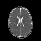 File:Bilateral mesial temporal polymicrogyria (Radiopaedia 76456-88181 Axial ADC 16).jpg