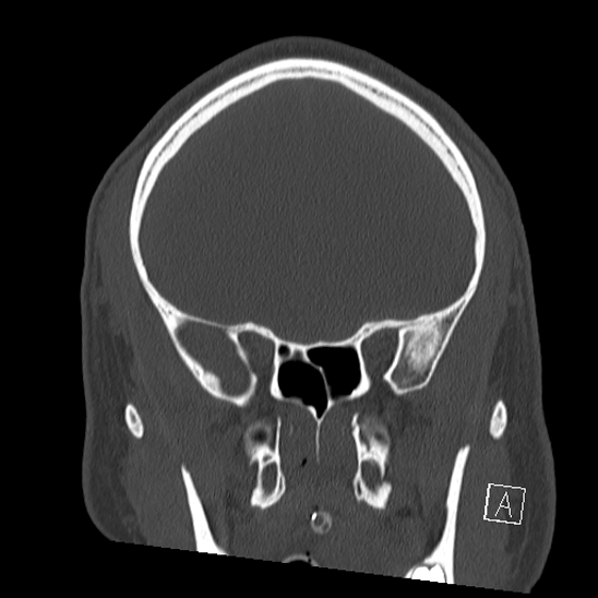Bilateral occipital condyle fracture (type 2) (Radiopaedia 87675-104089 Coronal bone window 33).jpg