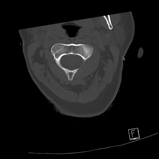 Bilateral occipital condyle fractures (type 3) (Radiopaedia 87672-104086 Axial bone window 22).jpg