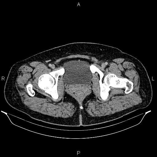 File:Bilateral ovarian dermoid cysts (Radiopaedia 85785-101603 A 106).jpg