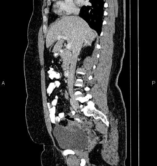 Bilateral ovarian dermoid cysts (Radiopaedia 85785-101603 D 37).jpg