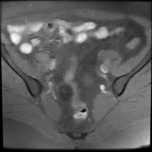 File:Bilateral ovarian dermoid cysts (Radiopaedia 90152-107338 Axial T1 fat sat 7).jpg