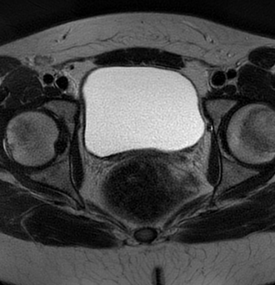 File:Bilateral ovarian fibrothecomas - adolescent (Radiopaedia 86604-102707 Axial T2 34).jpg