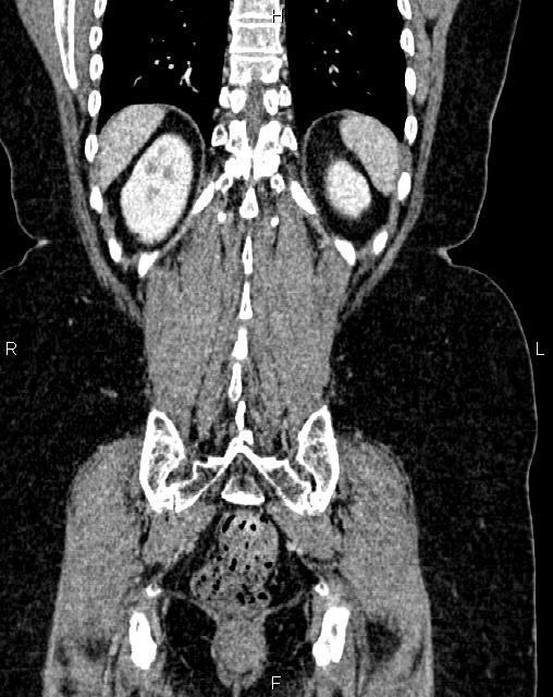 Bilateral ovarian serous cystadenocarcinoma (Radiopaedia 86062-101989 D 44).jpg
