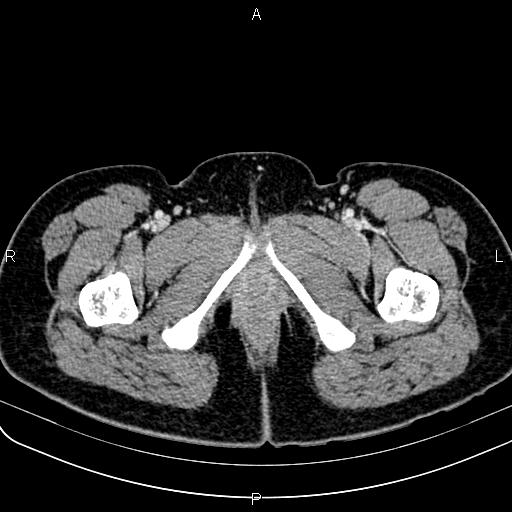 Bilateral ovarian teratoma (Radiopaedia 83131-97503 Axial With contrast 89).jpg