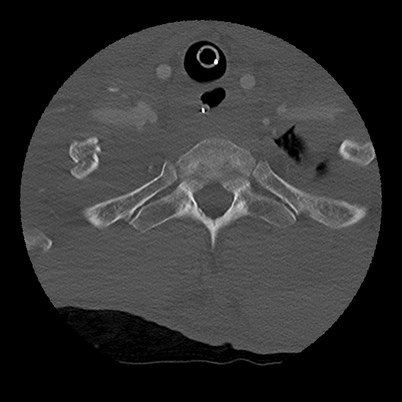 Bilateral perched facets with cord injury (Radiopaedia 45587-49713 Axial bone window 100).jpg
