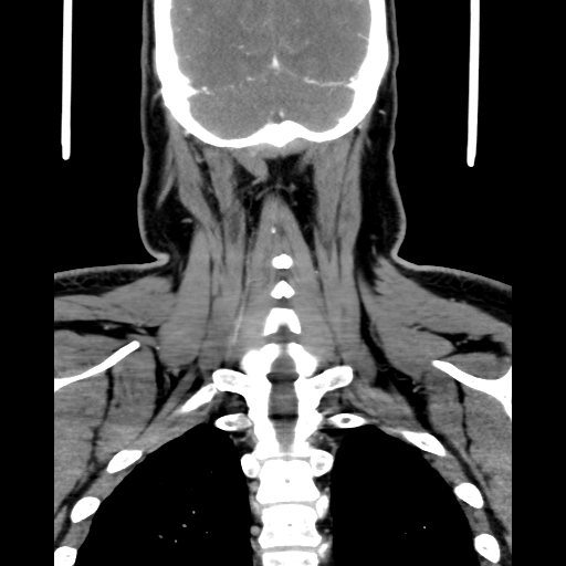Bilateral peritonsillar abscess (Radiopaedia 85065-100610 Coronal 60).jpg