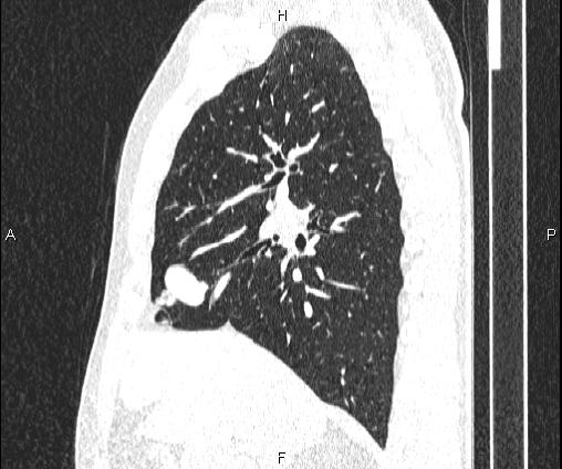 File:Bilateral pulmonary AVM (Radiopaedia 83134-97505 Sagittal lung window 47).jpg