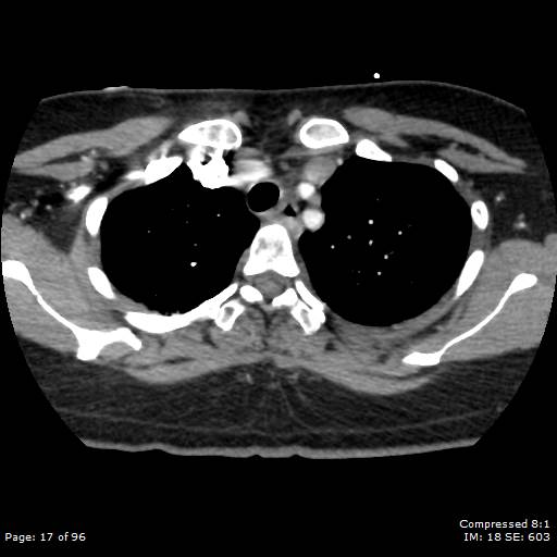 File:Bilateral pulmonary emboli with Hampton hump sign (Radiopaedia 54070-60246 Axial C+ CTPA 14).jpg