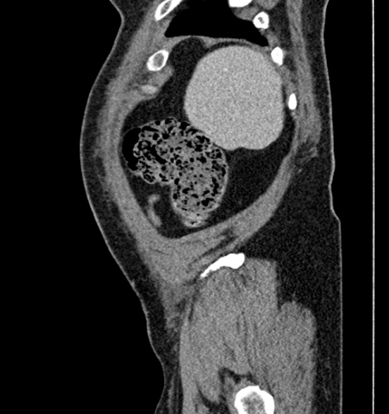 File:Bilateral rectus sheath hematomas (Radiopaedia 50778-56252 B 11).jpg