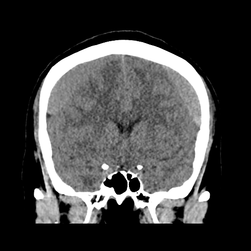Bilateral subacute subdural hematoma (Radiopaedia 69240-79018 Coronal non-contrast 22).jpg