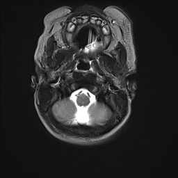 File:Bilateral subdural hemorrhage and parietal skull fracture (Radiopaedia 26058-26190 Axial T2 4).png
