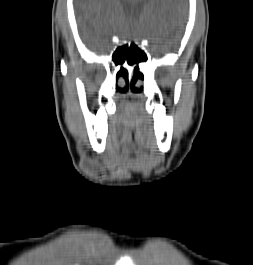 Bilateral submandibular sialolithiasis with sialadenitis (Radiopaedia 70721-80881 Coronal non-contrast 4).jpg