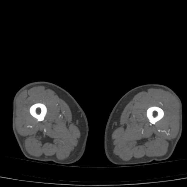 Bilateral superficial femoral arterial occlusion (Radiopaedia 25682-25857 A 44).jpg