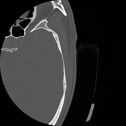 File:Bilateral temporal bone fractures (Radiopaedia 29482-29970 Axial 194).jpg