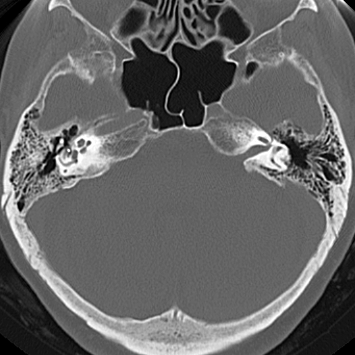 File:Bilateral tympanoplasty (Radiopaedia 16947-16664 Axial bone window 11).jpg