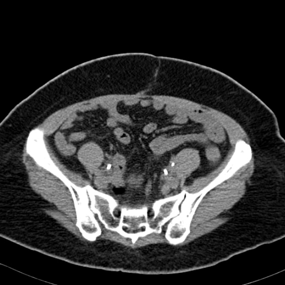 Bilateral ureteric stents (Radiopaedia 48795-53825 Axial non-contrast 47).jpg